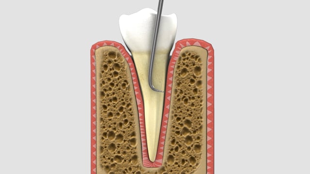 Deep Teeth Cleaning