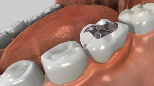 Replacing Old Silver or Gold Amalgam Fillings