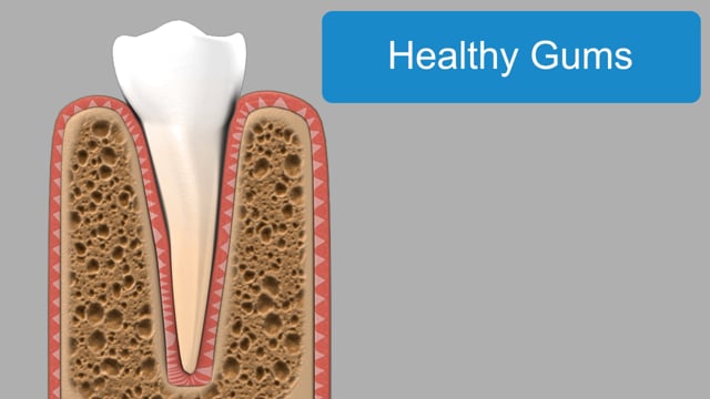 Stages Of Gum Disease