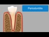 Periodontitis