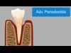 Advanced Periodontitis