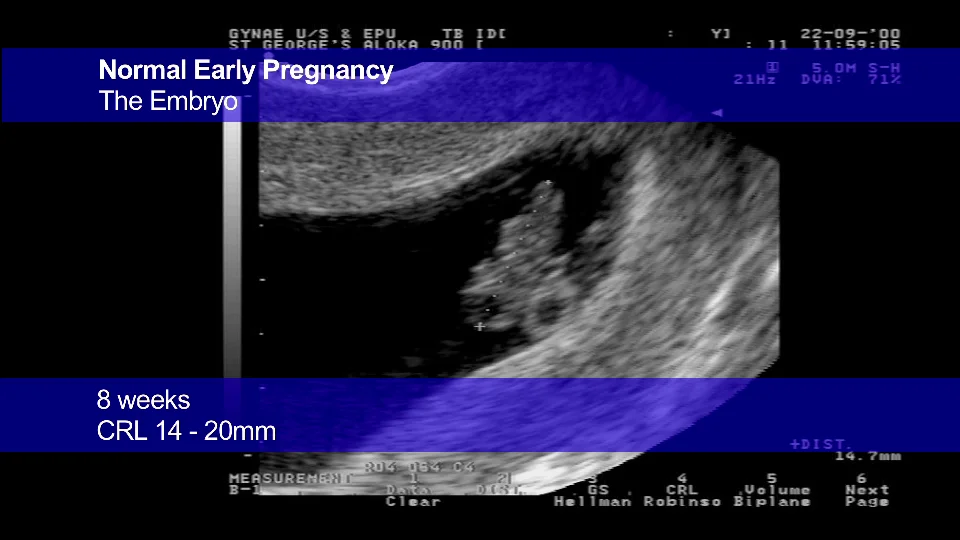 Obstetric Ultrasound Lecture Series Ultrasound Lecture Series Diagnosis Of Early Pregnancy