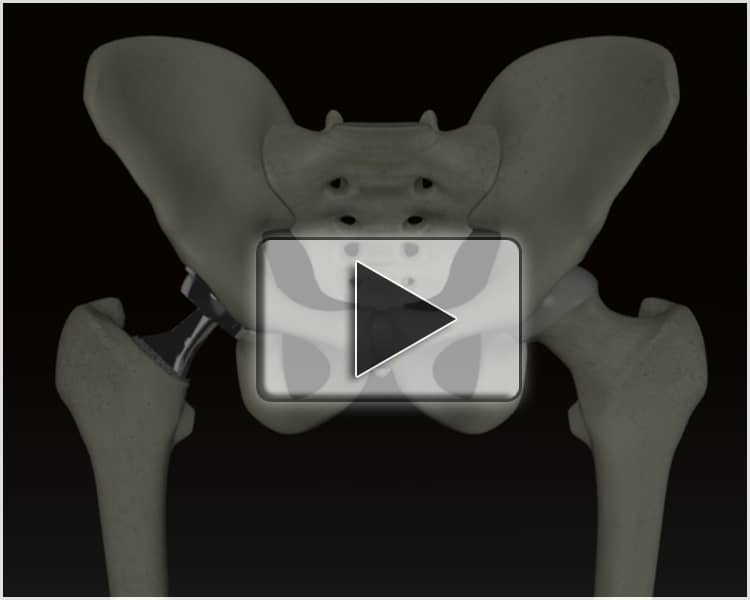 MetalonMetal Hip Replacement Recall Volume 1 Ions (MVI1101) on Vimeo
