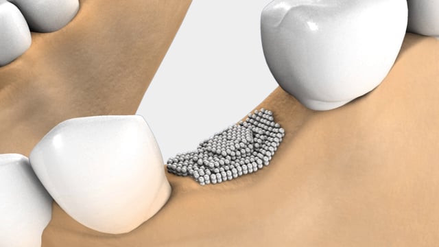 Bone Regeneration