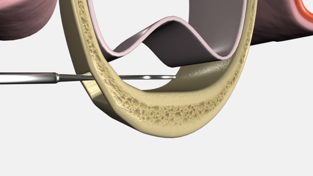 Sinus Lift