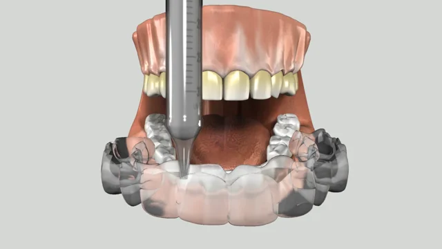 General Dentistry — Reflections Family Dentistry — Granite Bay, CA