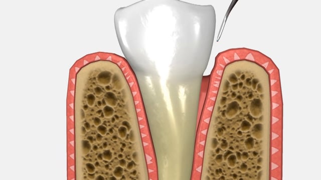 Soft Tissue Laser