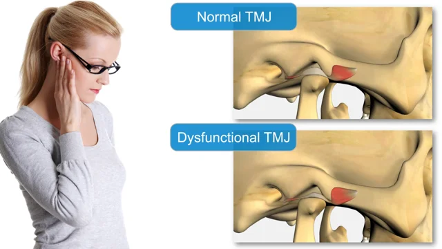 How Does a TENS Unit Help With TMJ (Temporomandibular Joint) Pain?