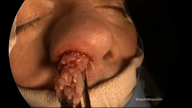 nasal papilloma