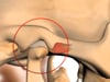 Dental Education Video - TMJ Bite Splints
