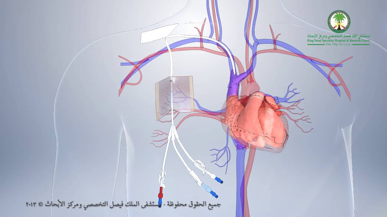 Hickman Line Insertion Procedure on Vimeo