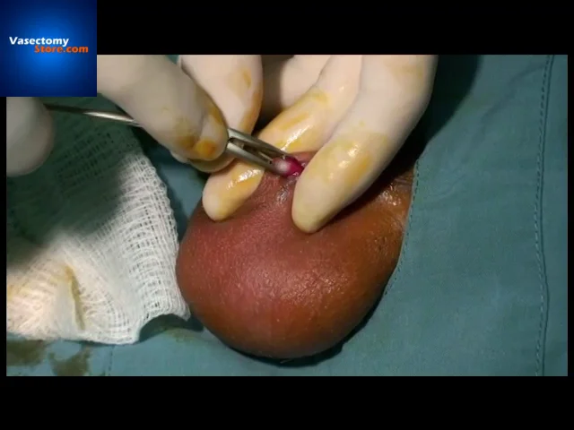 No Scalpel Vasectomy with No Needle Anesthesia HD Video -  VasectomyStore.com on Vimeo