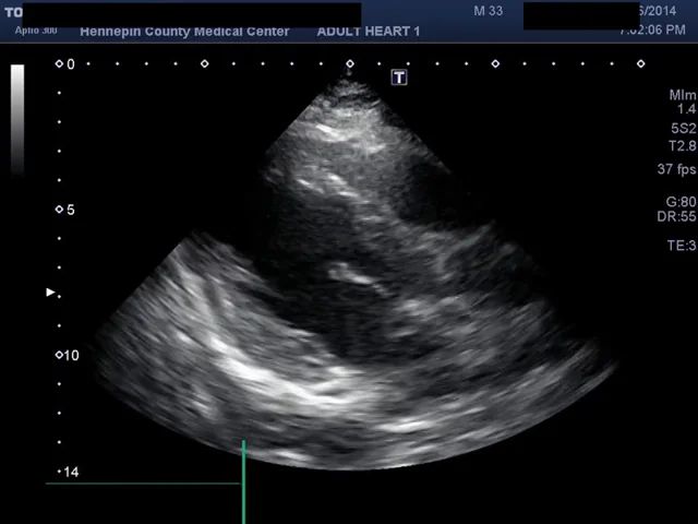 Hennepin Ultrasound  Right Ventricular Strain in Pulmonary Embolism