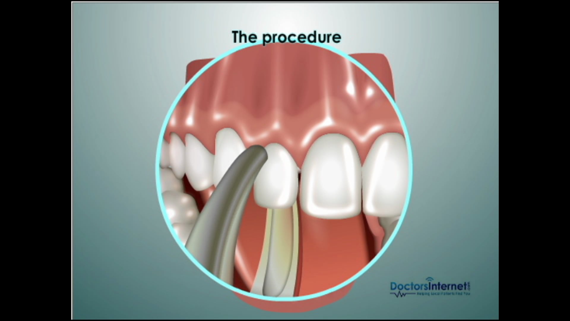 Extractions