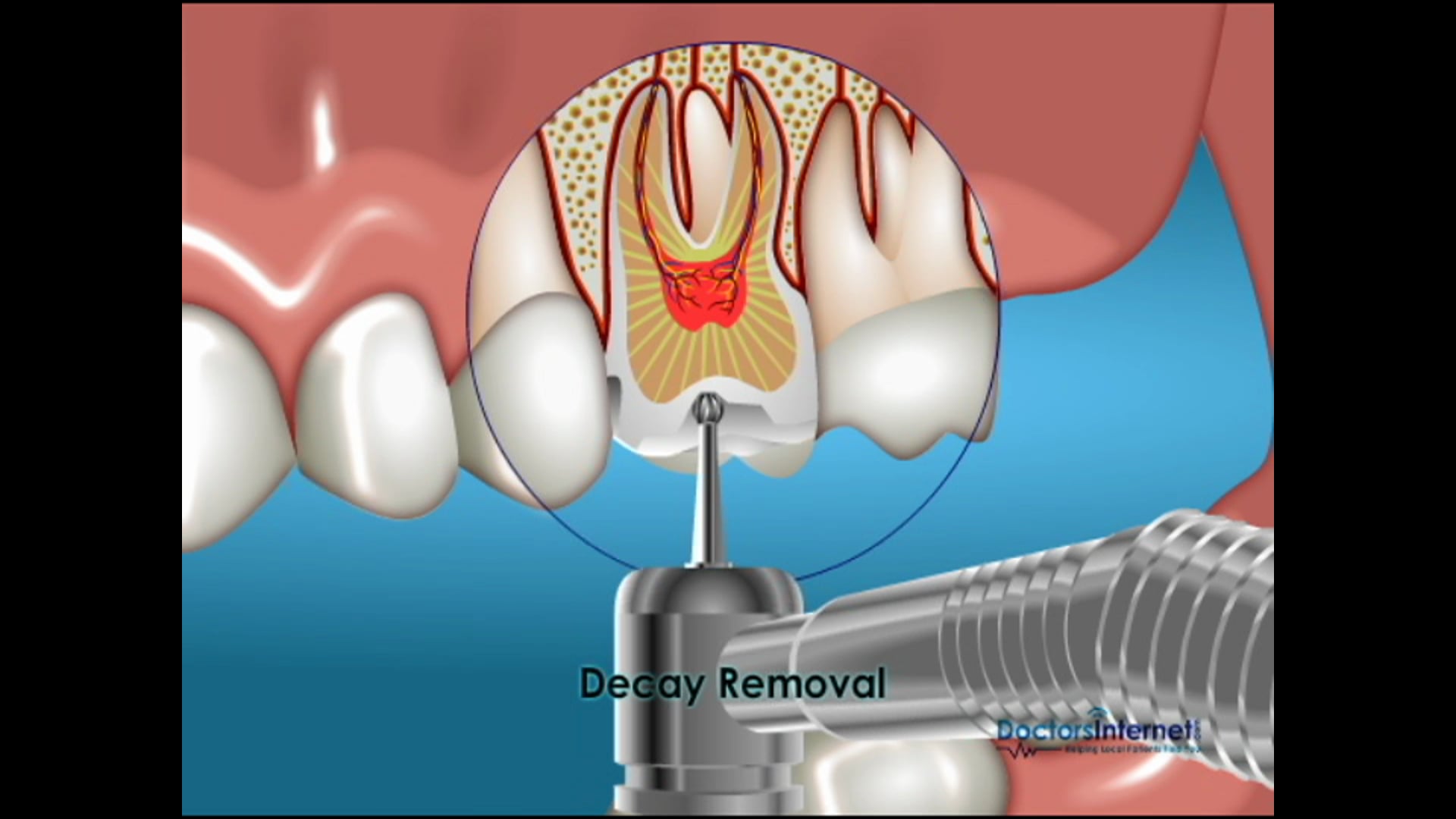 Fillings