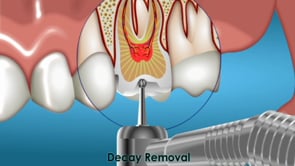 Fillings
