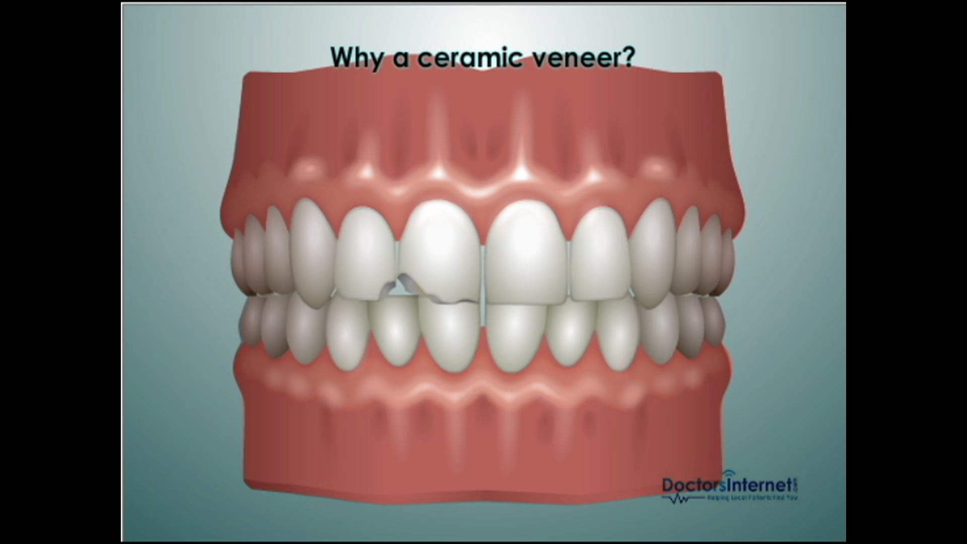 Veneers