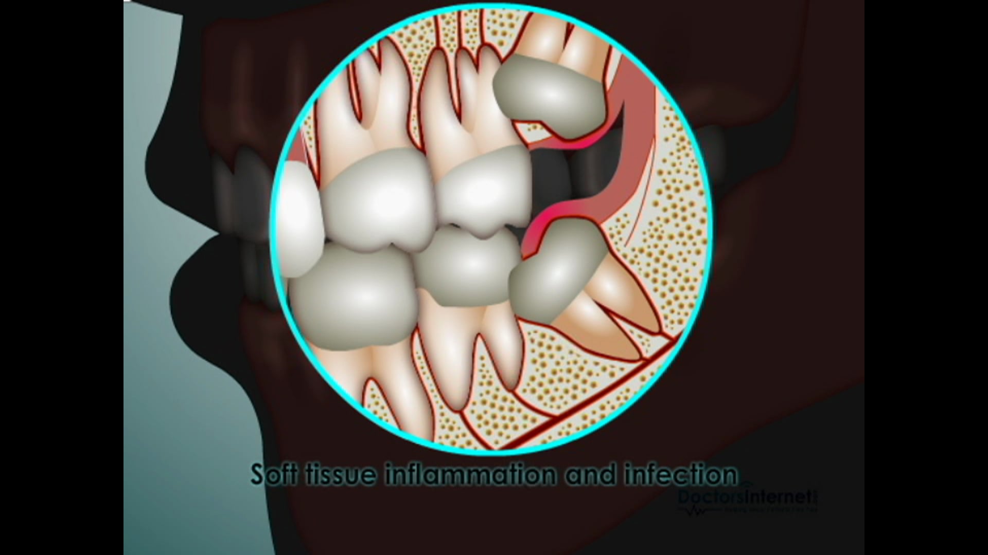 Wisdom Teeth