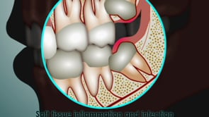 Wisdom Teeth