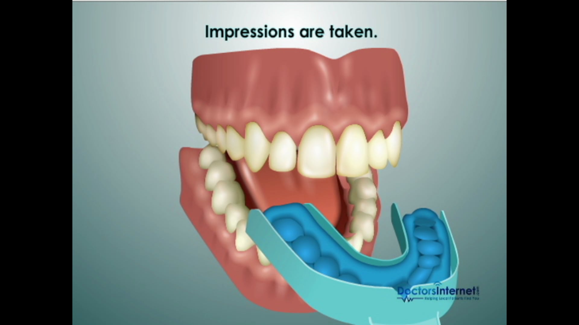 Home Tooth Whitening
