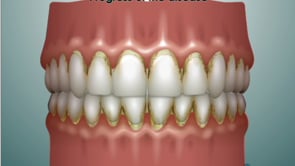 Periodontal Disease