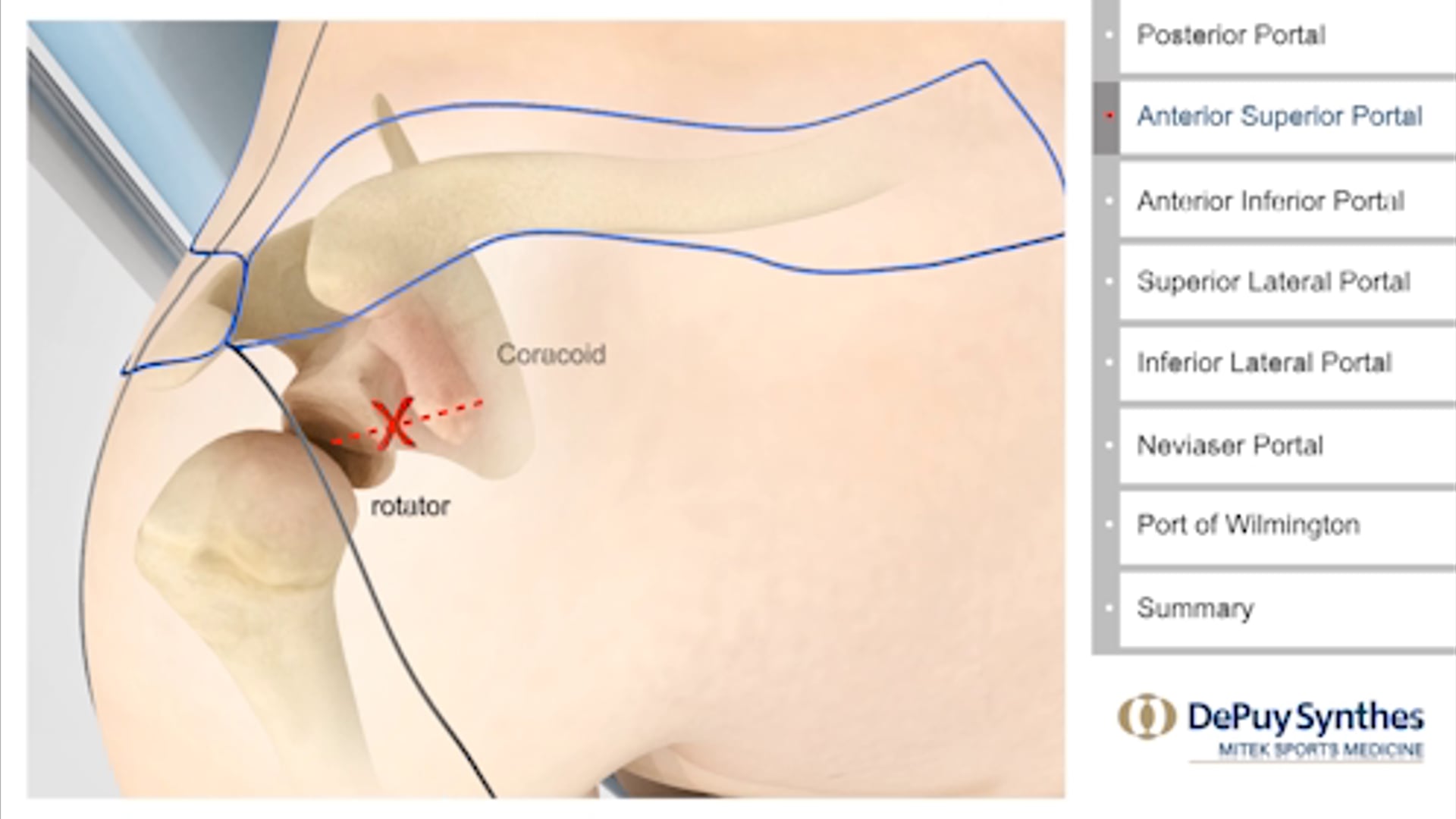 Professional Training: Arthroscopic Portals of the shoulder.    DePuy Mitek Sports Medicine | J&J Medical Devices: