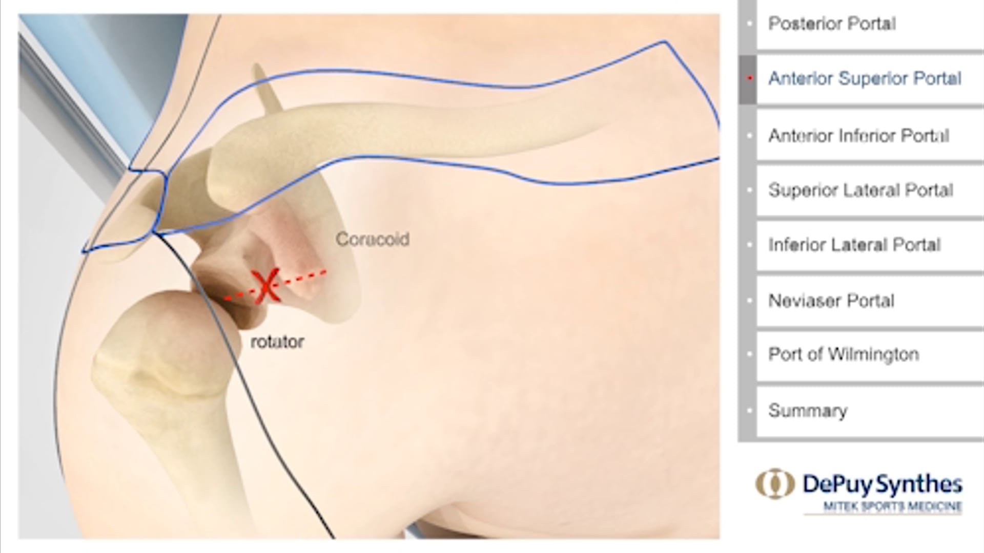 Professional Training: Arthroscopic Portals of the shoulder.    DePuy Mitek Sports Medicine | J&J Medical Devices: 