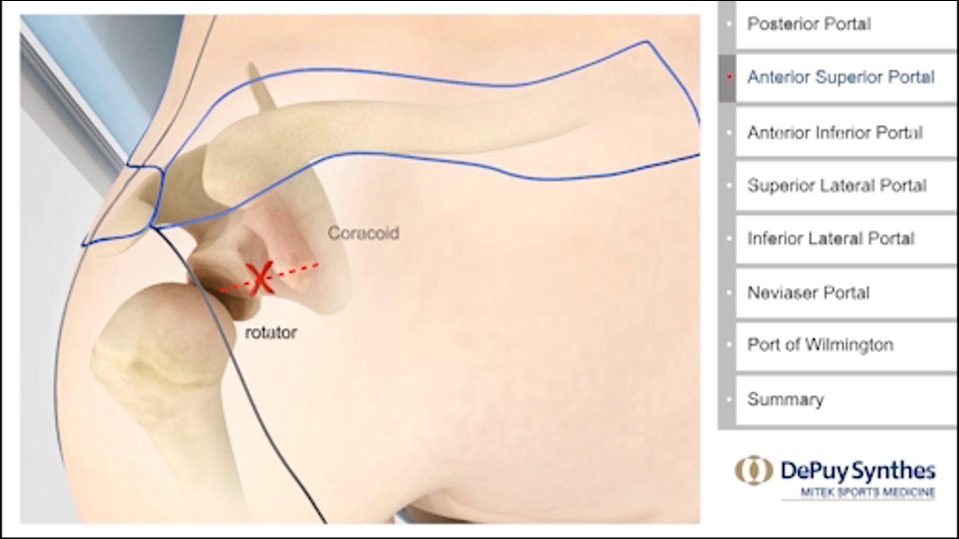 Professional Training: Arthroscopic Portals of the shoulder.    DePuy Mitek Sports Medicine | J&J Medical Devices: