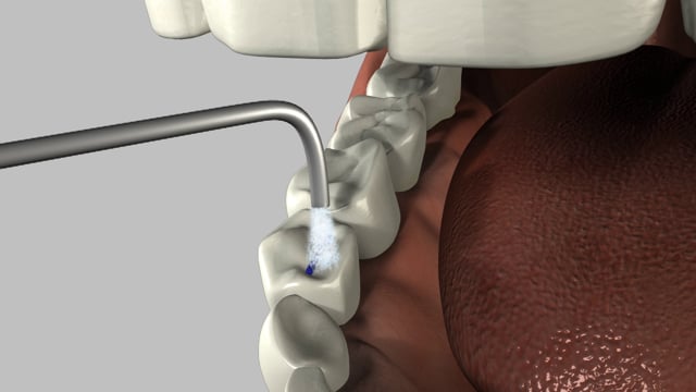 Applying Dental Sealants