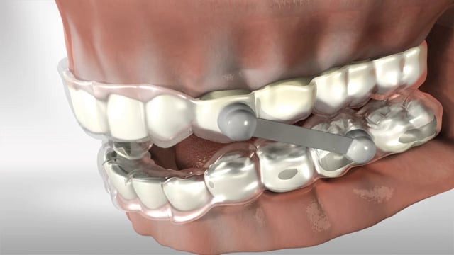 Sleep Apnea Snoring Appliance | Nobscot Dental Care