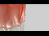 Frenectomy