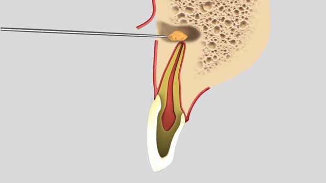 Apicoectomy