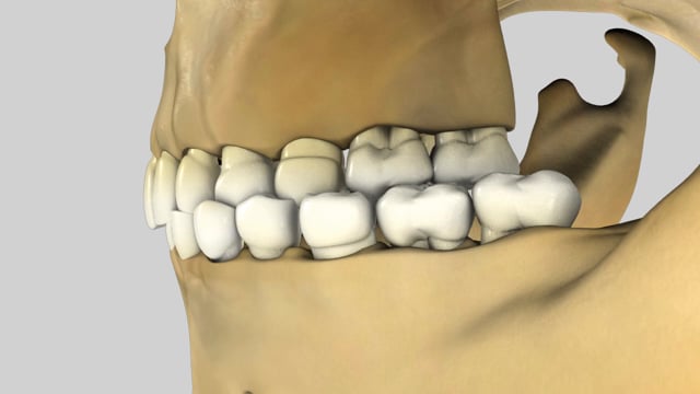 Posterior Cross Bite