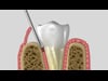 Flap Surgery