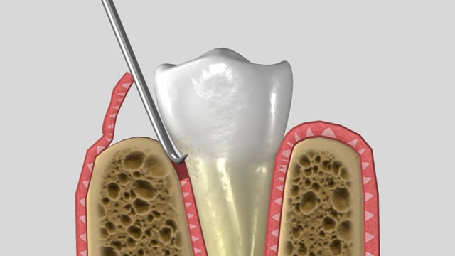 Gum Flap Surgery