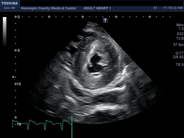 Hennepin Ultrasound