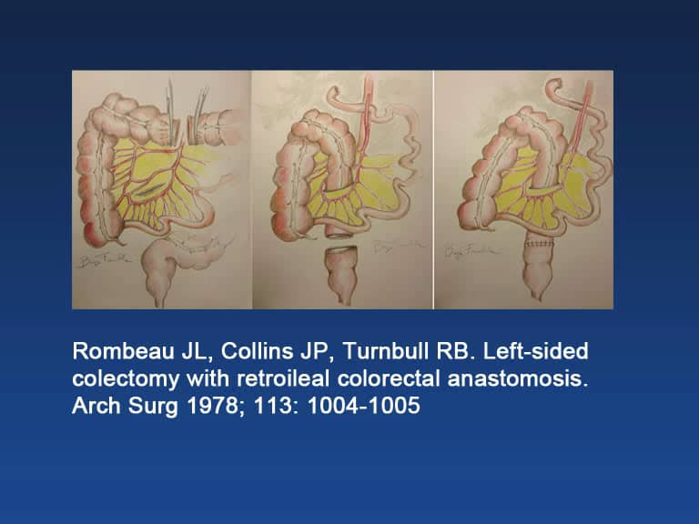 Laparoscopic Marginal Artery Injury at Splenic Flexure Mobilisation