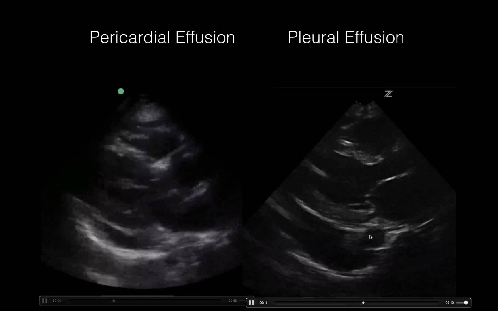 Cardiac Ultrasound: Pericardial vs Pleural effusion on Vimeo