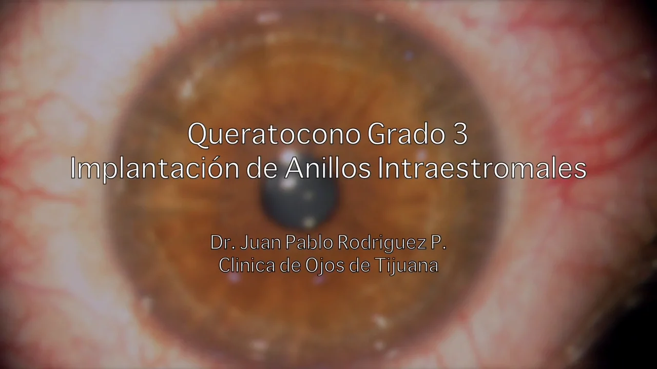 Anillos Intraestromales Dr. Juan Pablo Rodriguez