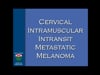 DR. ARIYAN, DR. CLUNE - Cervical Intramuscular Intransit Metastatic Melanoma - 5 minutes - 2014