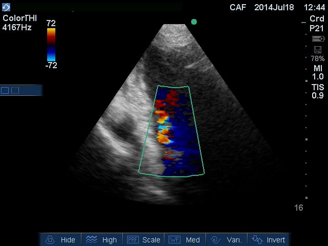 Normal Heart - Apical long colour JB on Vimeo