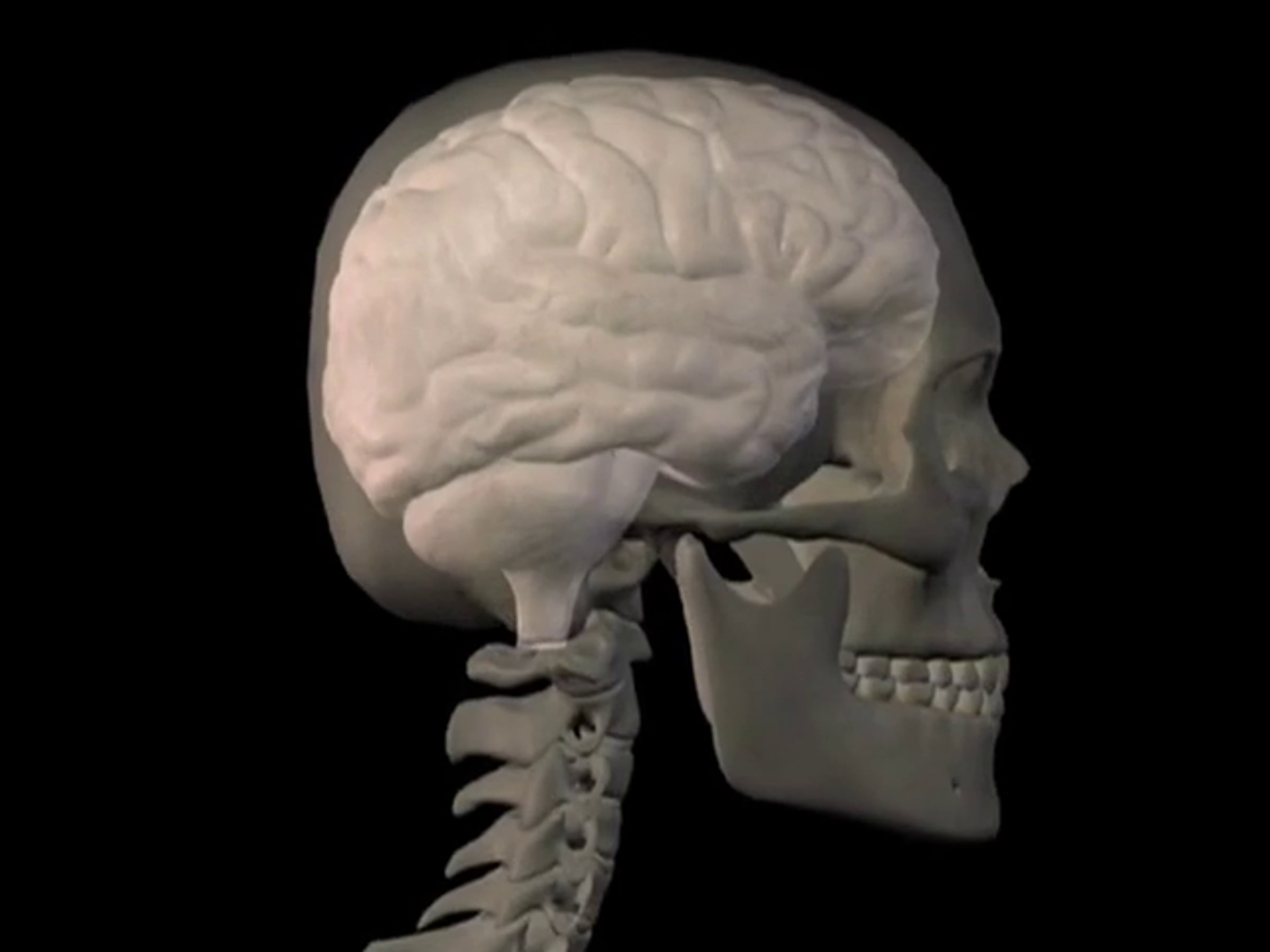 Brain Hemorrhage - Medical Animation | Videos & Movies on Vimeo