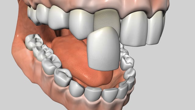 Porcelain Veneers