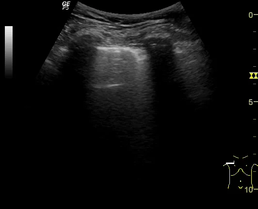 Lung B lines - Rockets WITH harmonics and multibeam Bowra on Vimeo
