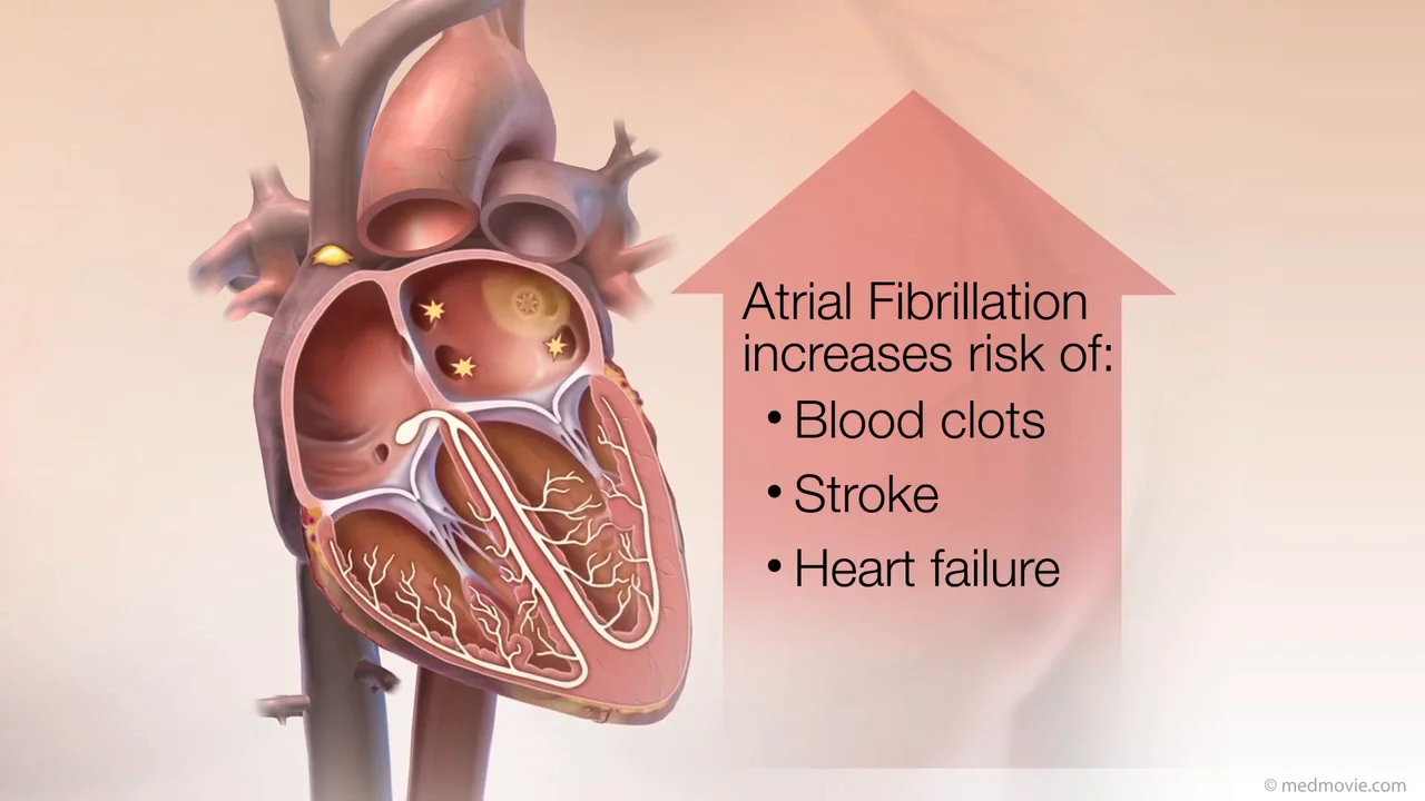 Atrial Fibrillation Complications