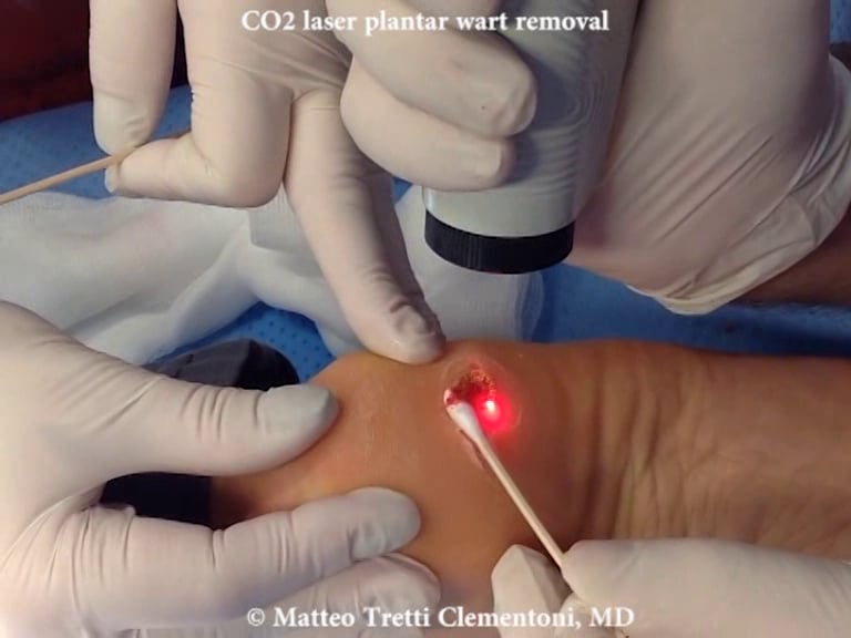 CO2 laser plantar wart removal on Vimeo
