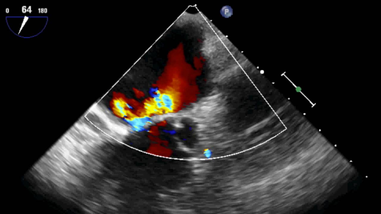 Coanda Effect (severe mitral regurgitation) on Vimeo