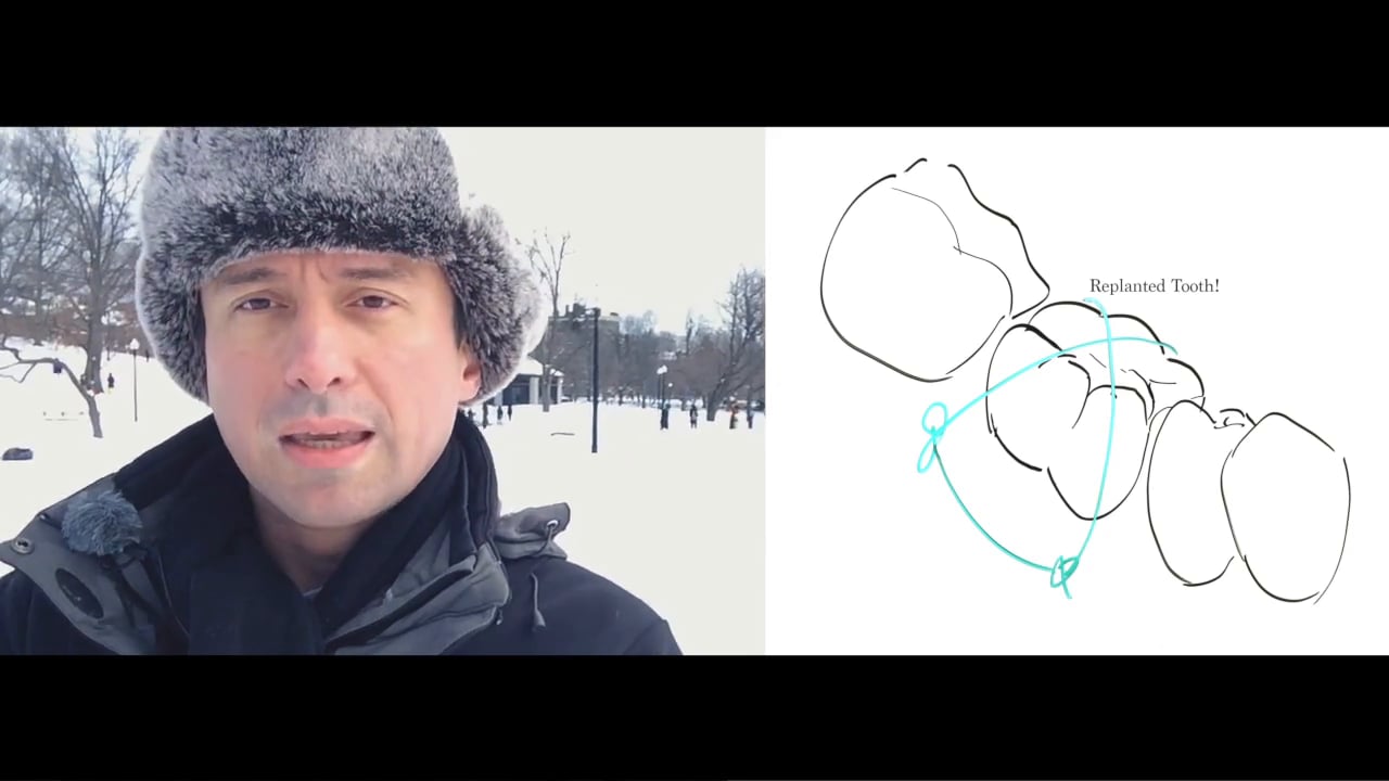 What are PostOp instructions for Intentional Replantations? (Friday Questions) Real World