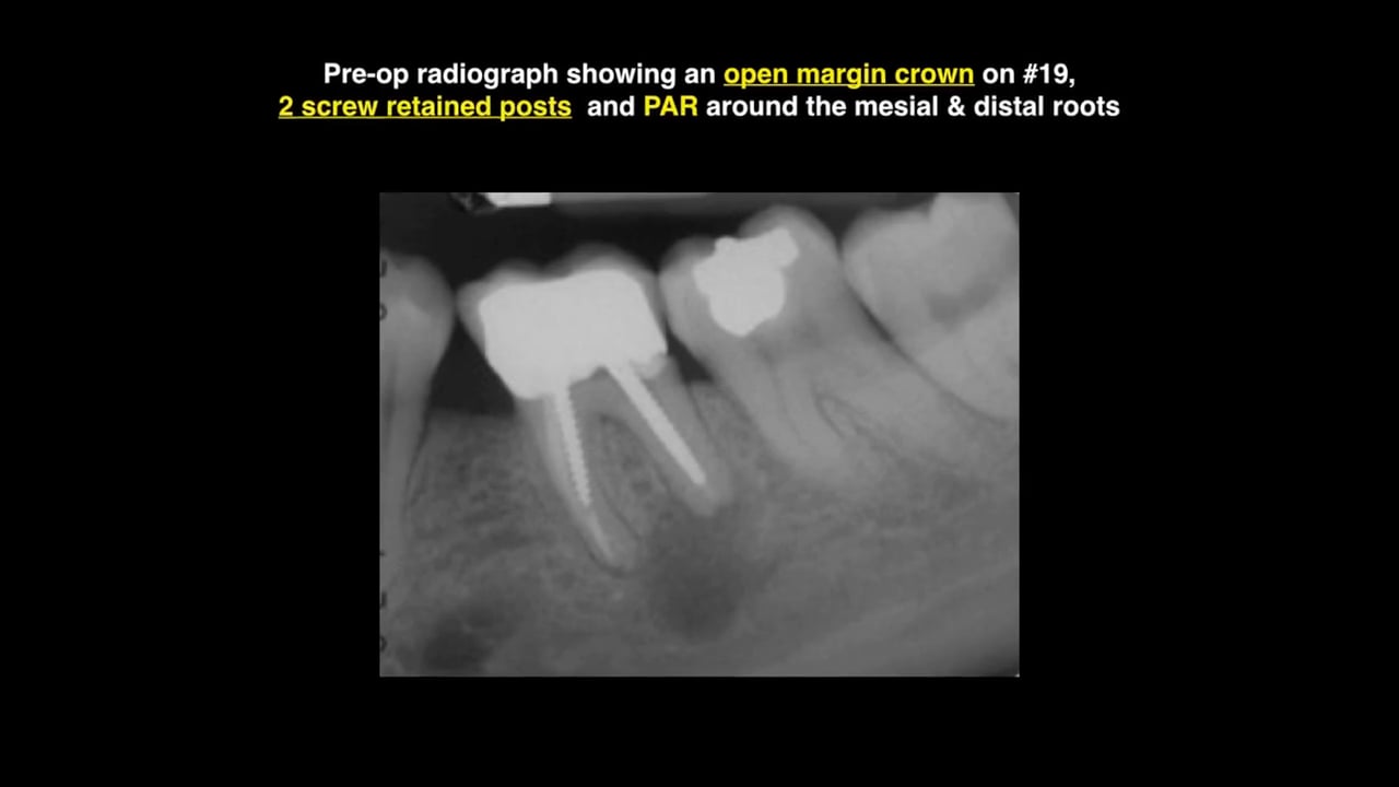 Cases RWE-EndoLit Interview with Dr. Gianluca Plotino - Real World Endo ...