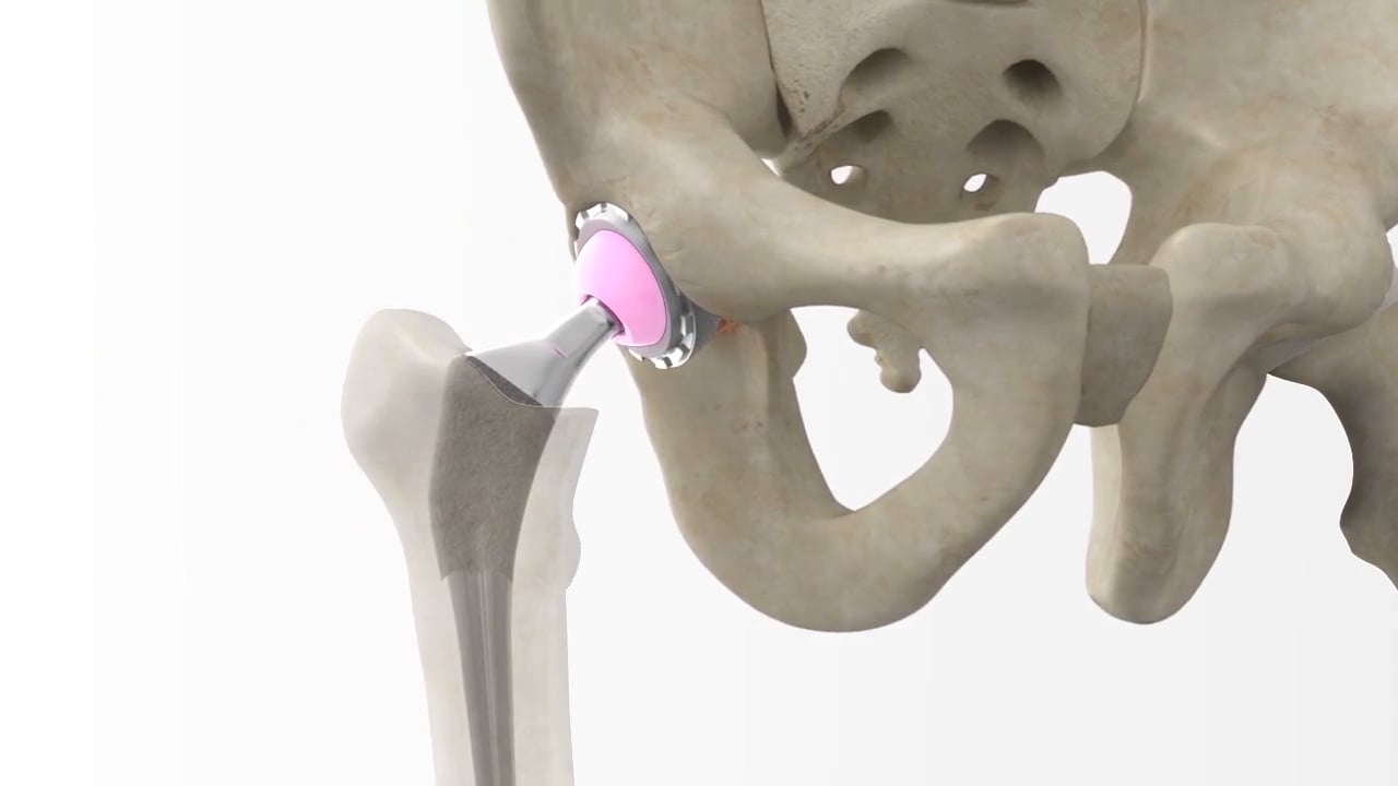 Anterior Approach Hip Patient Animation